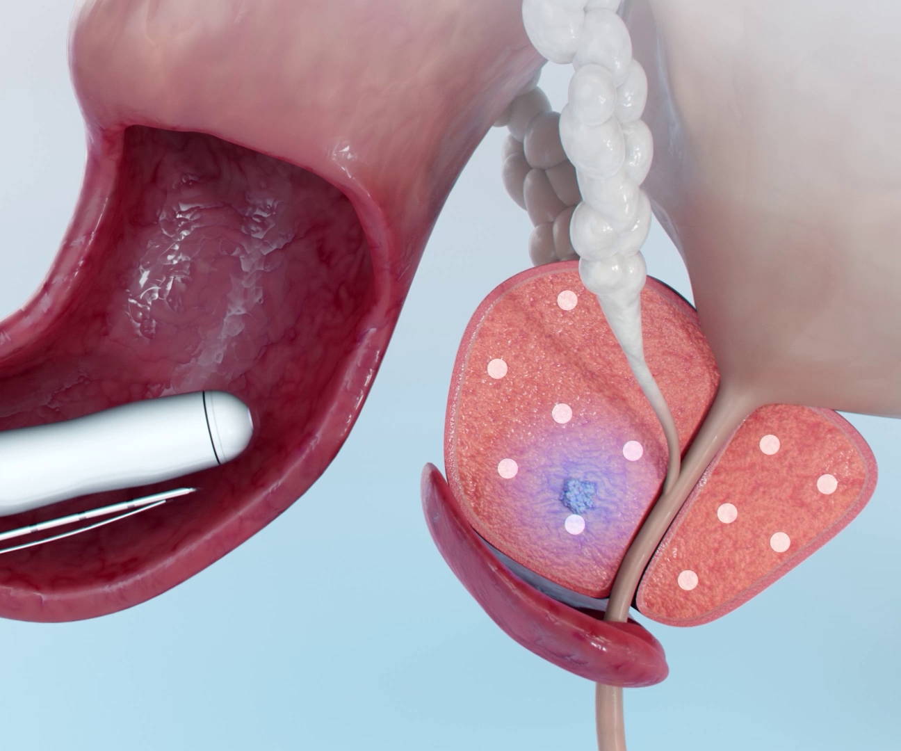 prostage cancer diagnosis