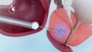 hitting target prostate cancer