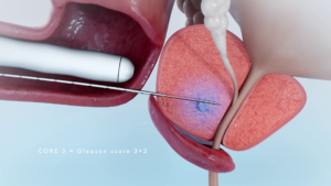 missing target prostate cancer